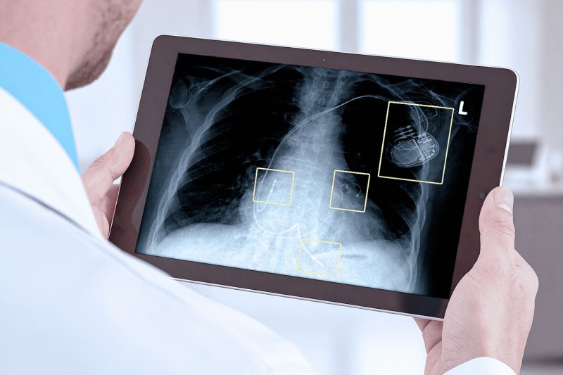 Umicore MDS - PLATUNA PT - Platinum coating for medical technology - Implant technology